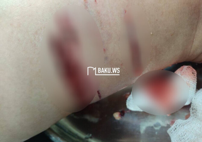 Sahibsiz itlər Xırdalanda sakinə hücum etdilər - FOTO/VİDEO