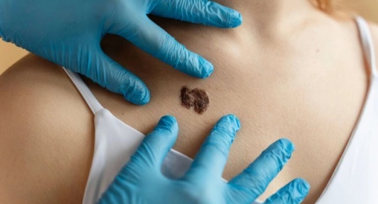 Dəri xərçəngini erkən mərhələdə aşkar edən plastır yaradılıb