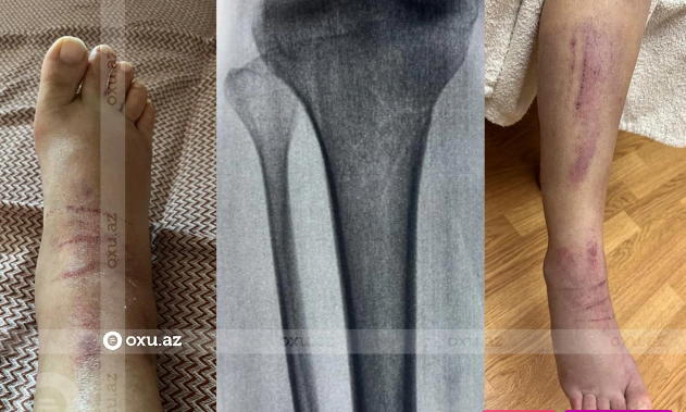 Piyada zolağında ana və iki övladını vuran "Avromed" şirkətinin sürücüsü yoxa çıxıb - ŞİKAYƏT