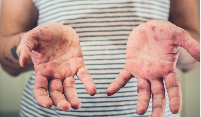 Halsızlıq, qızdırma və səpgilər: Türkiyəni ağuşuna alan xəstəlik Azərbaycana gəlir?