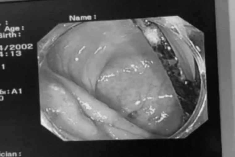 Aylarla keçməyən mədə ağrısından əziyyət çəkirdi! Bağırsaqlarından gorün nə çıxdı - Həkimlər də təəccübləndilər