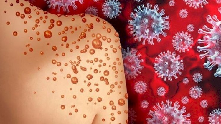 Azərbaycanlı alimdən "Meymun çiçəyi" ilə bağlı şok AÇIQLAMA