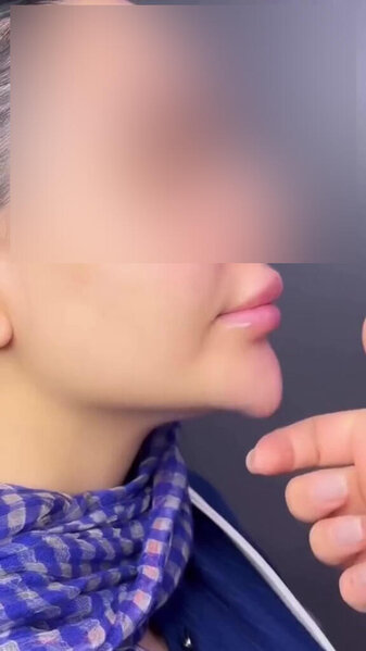 Bakıda üzünə dolğu etdirən qadının çənəsi əyildi - FOTO