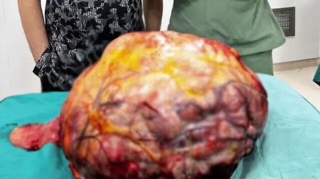 Ağrıdan şikayət edərək həkimə müraciət edən xəstə qarnından çıxarılanlara inana bilməyib - FOTO