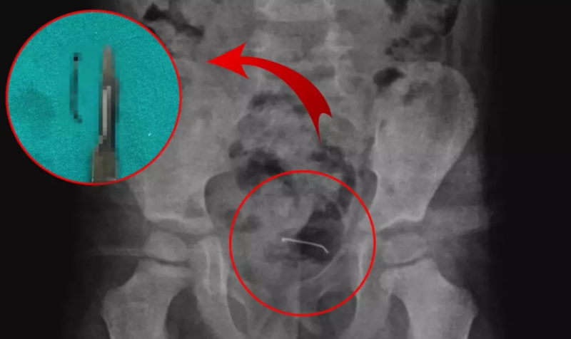 5 yaşlı uşağın bədənində metal əşya aşkar edilib