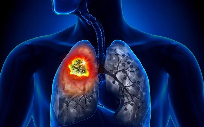 Alimlər ölümcül ağciyər xəstəliyinin səbəbini aşkarlayıblar