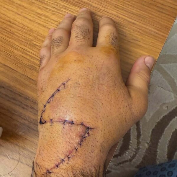 Rafael Ağayev 1 gündə ikinci dəfə əməliyyat olunubmuş - FOTO