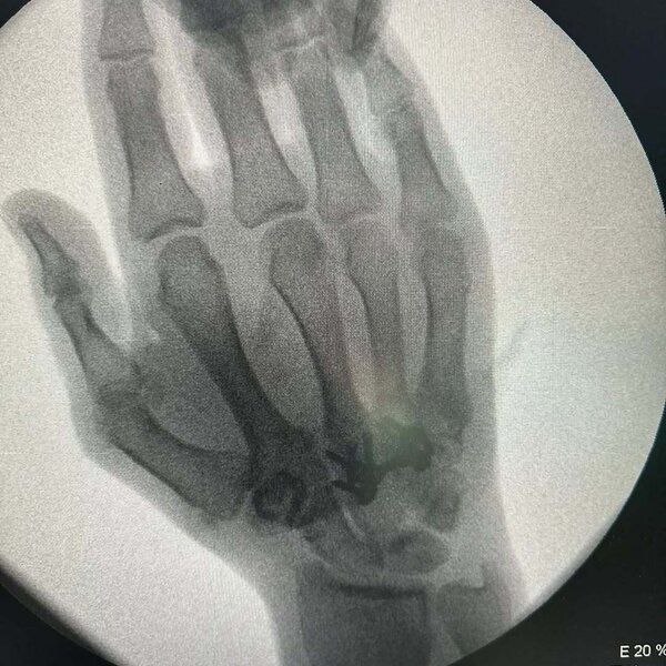 Rafael Ağayev 1 gündə ikinci dəfə əməliyyat olunubmuş - FOTO