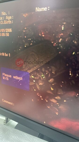 Bakıda bir nəfər 9 ədəd qaşıq uddu (FOTO)