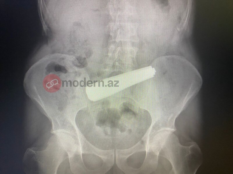 Bakıda bir nəfər 9 ədəd qaşıq uddu (FOTO)