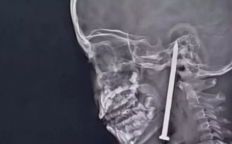 Beyninə metal parçası saplanan azyaşlı qız möcüzəvi şəkildə sağaldı