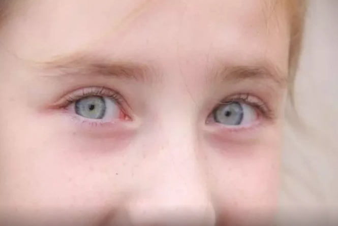 Uşağın görməsinin pisləşdiyini bildirən əlamətlər