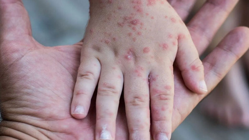 Hazırda Azərbaycanda qızılcaya yoluxma var? (RƏSMİ)