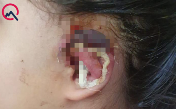 "Həkimin əməliyyatından sonra qızımın qulağında çürümə oldu" (FOTO)