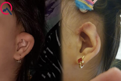 "Həkimin əməliyyatından sonra qızımın qulağında çürümə oldu" (FOTO)