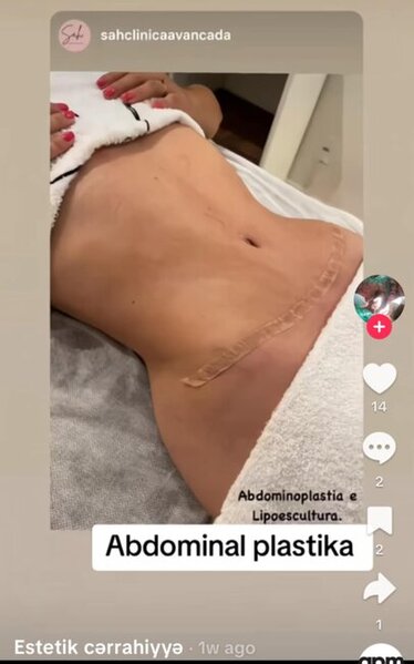 Dr.Ella necə estetik əməliyyatlar icra edir? -Araşdırma