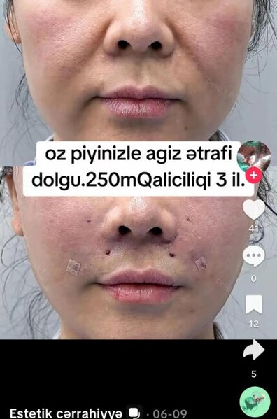 Dr.Ella necə estetik əməliyyatlar icra edir? -Araşdırma