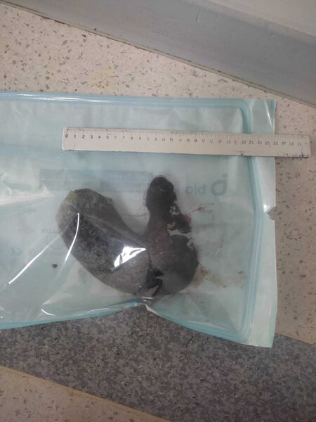 Azyaşlının mədəsindən saç kütləsi çıxarıldı