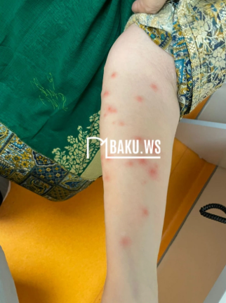 Nəbatat bağından daha bir ŞİKAYƏT: "Bütün gecəni qaşınmışıq..."