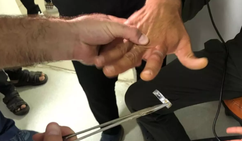 Barmağında ilişib qalan üzük xilasedicilər tərəfindən çıxarıldı