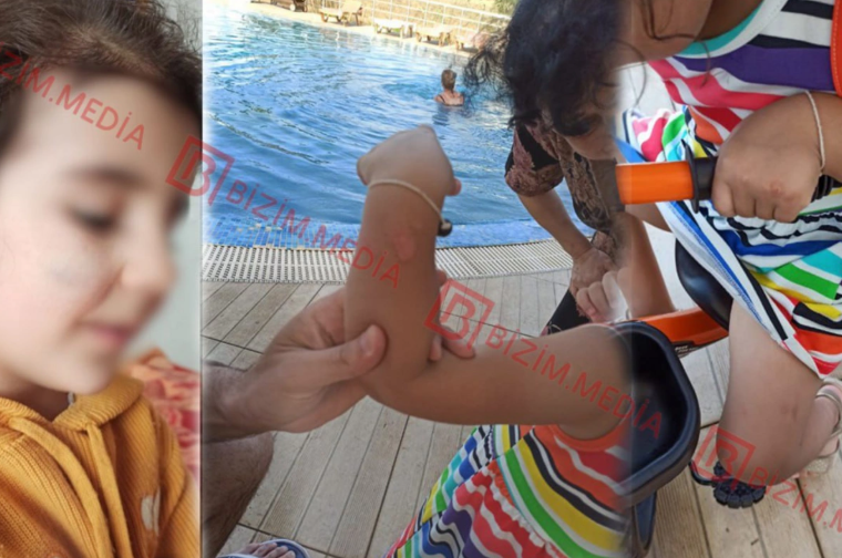 Lənkəranda qandonduran HADİSƏ – Ana isti qaşıqla 3 yaşlı qızının qolunu DAĞLADI