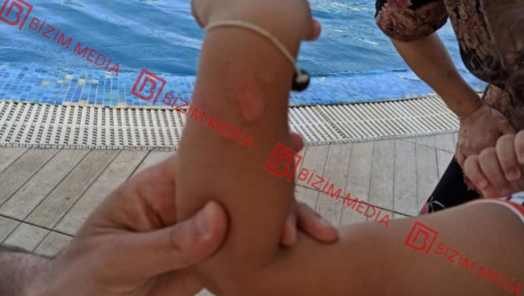 Lənkəranda qandonduran HADİSƏ – Ana isti qaşıqla 3 yaşlı qızının qolunu DAĞLADI