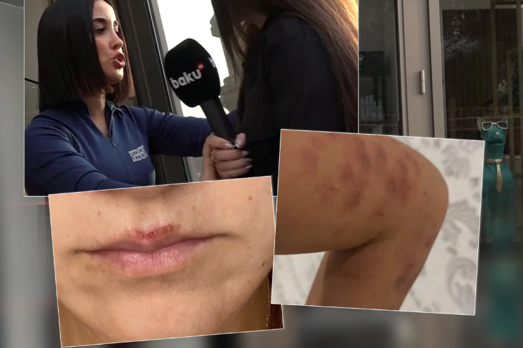 Bakıda salonda qadını lazer edərkən yandırdılar - İDDİA