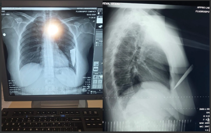 Toydan çıxarkən bıçaqlanan davulçu sabiq sevgilisindən şikayətçi, həyatından narahatdır