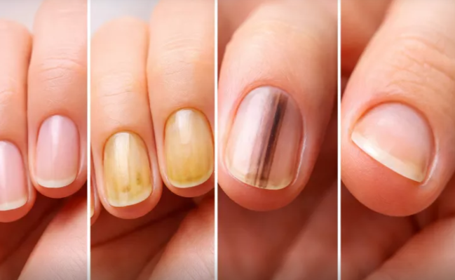 Hansı dırnaq dəyişiklikləri xəstəliklərə işarə edir