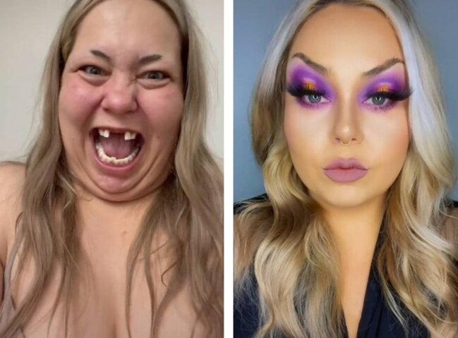 Dişsiz "çirkin ördəkdən" gözələ çevrilib söyüldü - FOTO-VİDEO