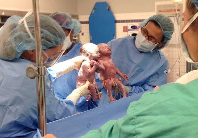 Doğulanda əl-ələ tutan əkizlər indi də ayrılmırlar - FOTOLAR