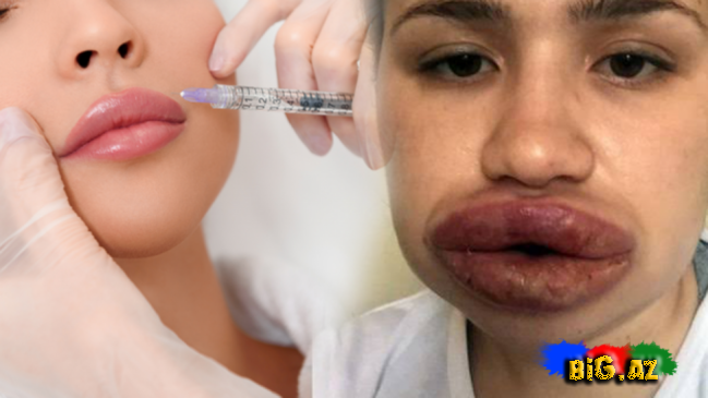 Botoks iflic edir? - ŞOK AÇIQLAMA