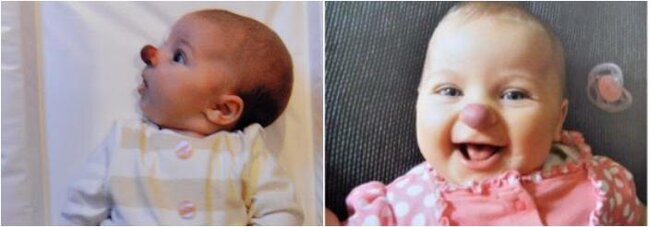 Bu qız "təlxək burnu" ilə doğulub - İllər sonrakı HALI - FOTO
