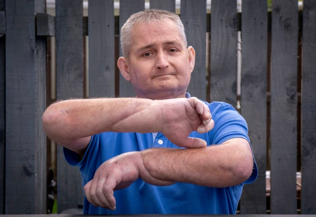 İki əlini də kəsib yenilərini tikdilər - FOTO-VİDEO +18