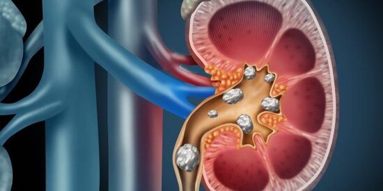 Böyrəkdaşı xəstəliyinin səbəbləri