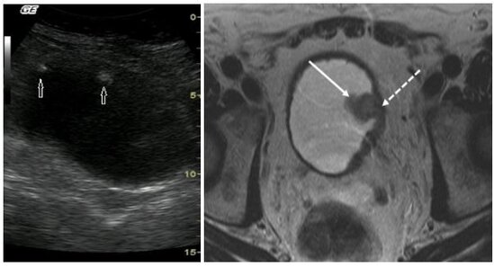 Qadının sidik kisəsindən stəkan çıxarıldı