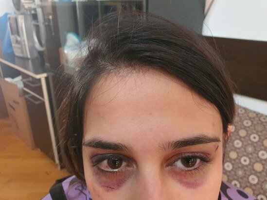 Ailə FACİƏSİ: Qadın körpəsini qoruduğu üçün əri tərəfindən döyüldü