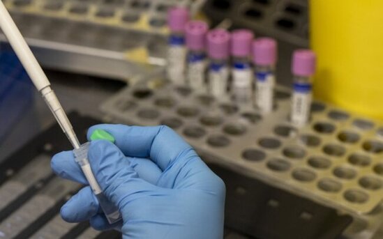 Azərbaycana meymunçiçəyi test dəstləri gətirildi