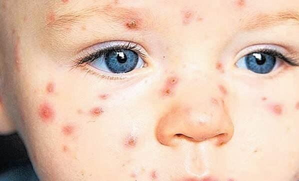 500 milyon insanı öldürən XƏSTƏLİK geri qayıdır