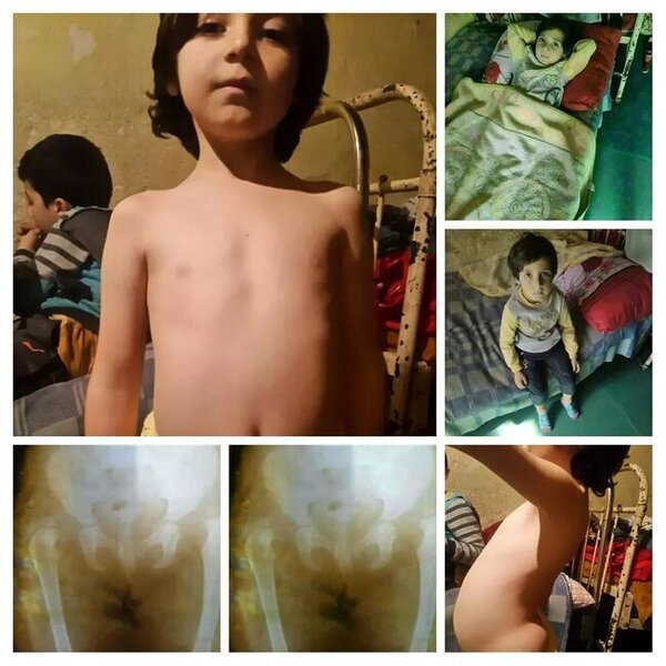 Balaca Aytəndən ŞAD XƏBƏR: Əməliyyat olundu - FOTO-VİDEO