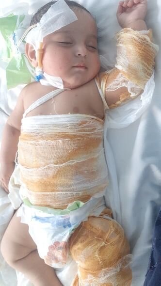 Yeddi aylıq körpə qaynar suda yanıb - FOTO