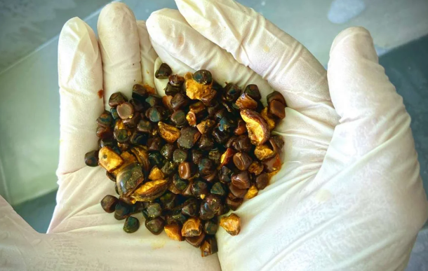 Rusiyada qəribə biznes: Vətəndaşlar öd kisəsi daşlarını satışa çıxarırlar