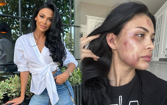 Azərbaycanlı model sevgilisi tərəfindən döyüldü - Foto