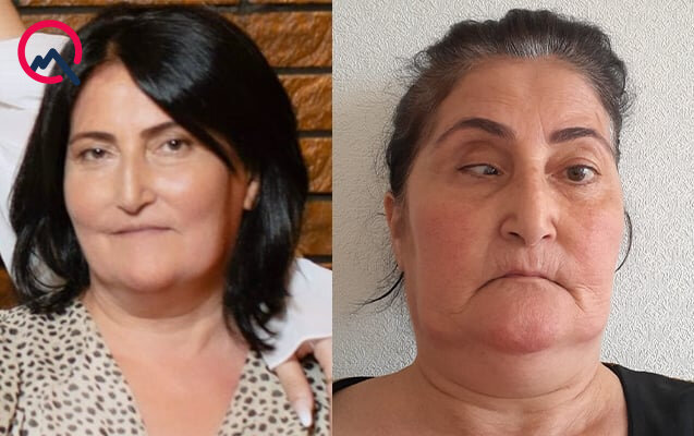 Bu klinika təzminat ödəyəcək - Burun düzəldəndə gözü zədələyib