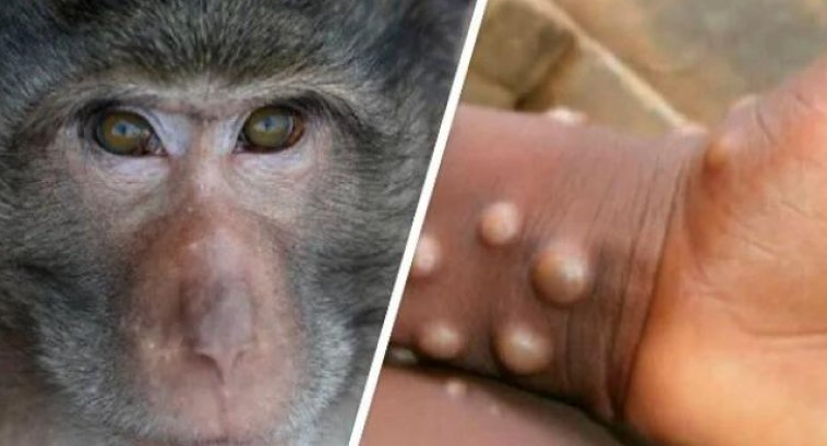 Meymunçiçəyi virusu sürətlə yayılır - ÜST həyəcan təbili çaldı