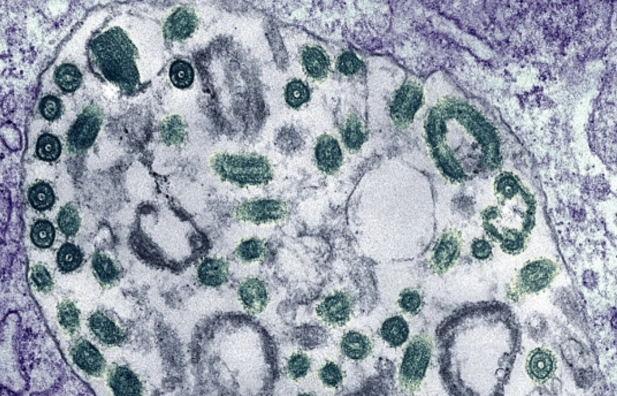 Efiopiyada təhlükəli virusun yayıldığı təsdiqlənib