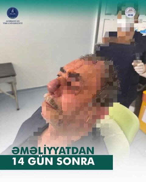 İt dişləməsi nəticəsində burnunu itirən xəstəyə yeni burun formalaşdırıldı - Azərbaycanda unikal əməliyyat