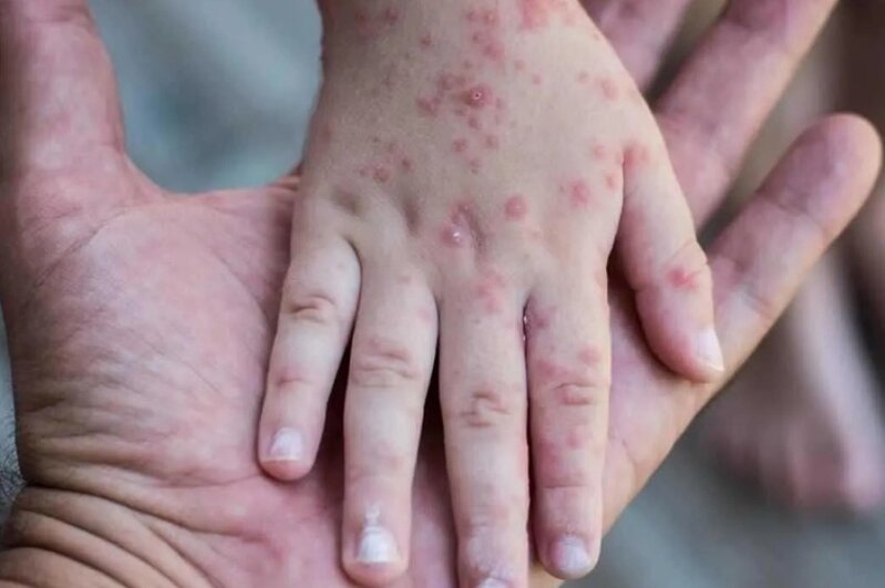 Uşaq qənimi qızılca nə vaxt bitəcək - tüğyan edən virusların adı