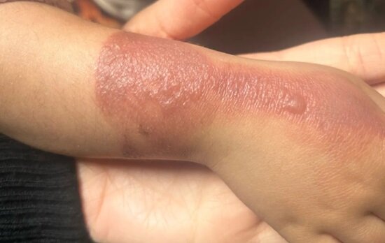 Uşaqlarda yanıq olan zaman valideynlərin yol verdiyi səhvlər - FOTO