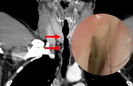 Nadir görülən xəstəlik: Boğazında durmadan uzanan tüklər həkimləri təəccübləndirdi